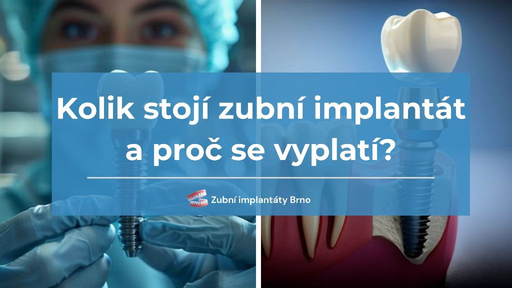 Kolik stojí zubní implantát a proč se vyplatí?