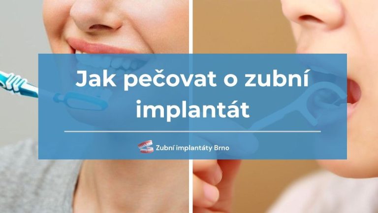 Jak pečovat o zubní implantát: domácí rutina a role dentální hygieny - All on 6® Brno: Revoluční řešení pro dokonalý úsměv