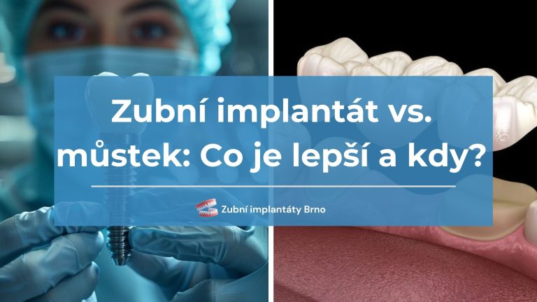Zubní implantát vs. můstek Co je lepší a kdy